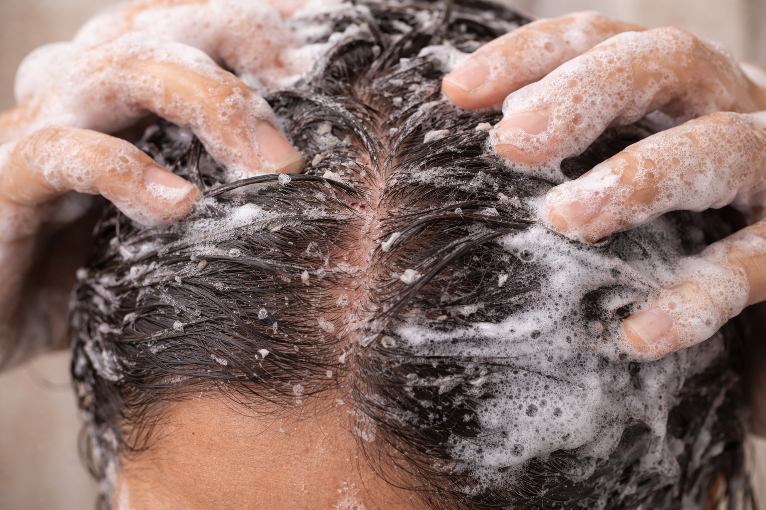 Dandruff Control: Balance Over Aggression – Ayurveda – Vanya Veda Lab